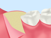 親知らずの抜歯の流れ STEP01