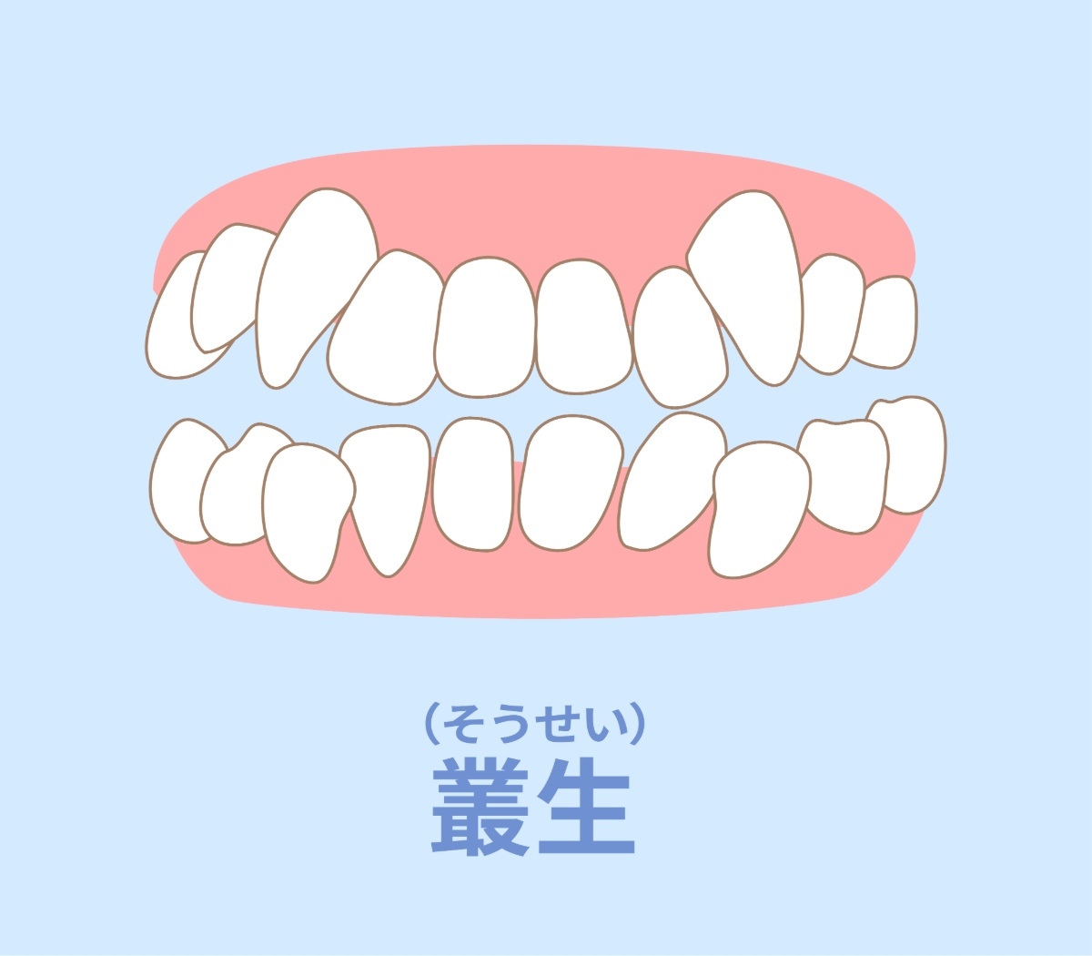 八重歯の構造イメージ