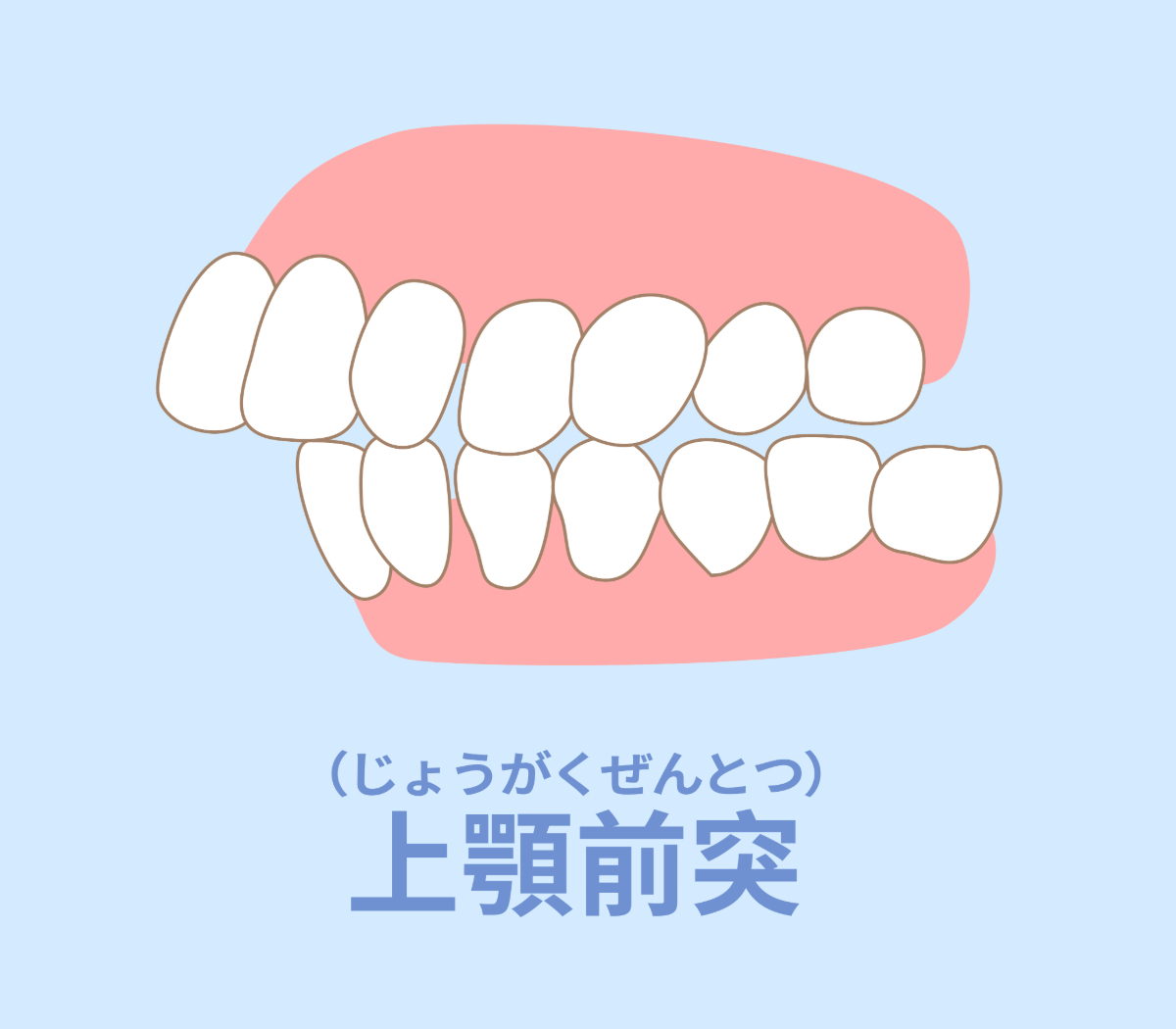 不正咬合の種類の1つである上顎前突（出っ歯）