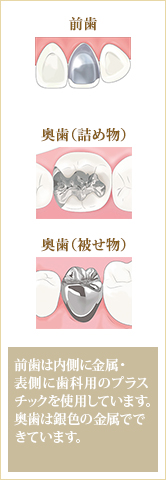 アース歯科クリニック　歯医者　板橋　詰め物・被せ物が取れてしまったときは、すぐにご相談ください
