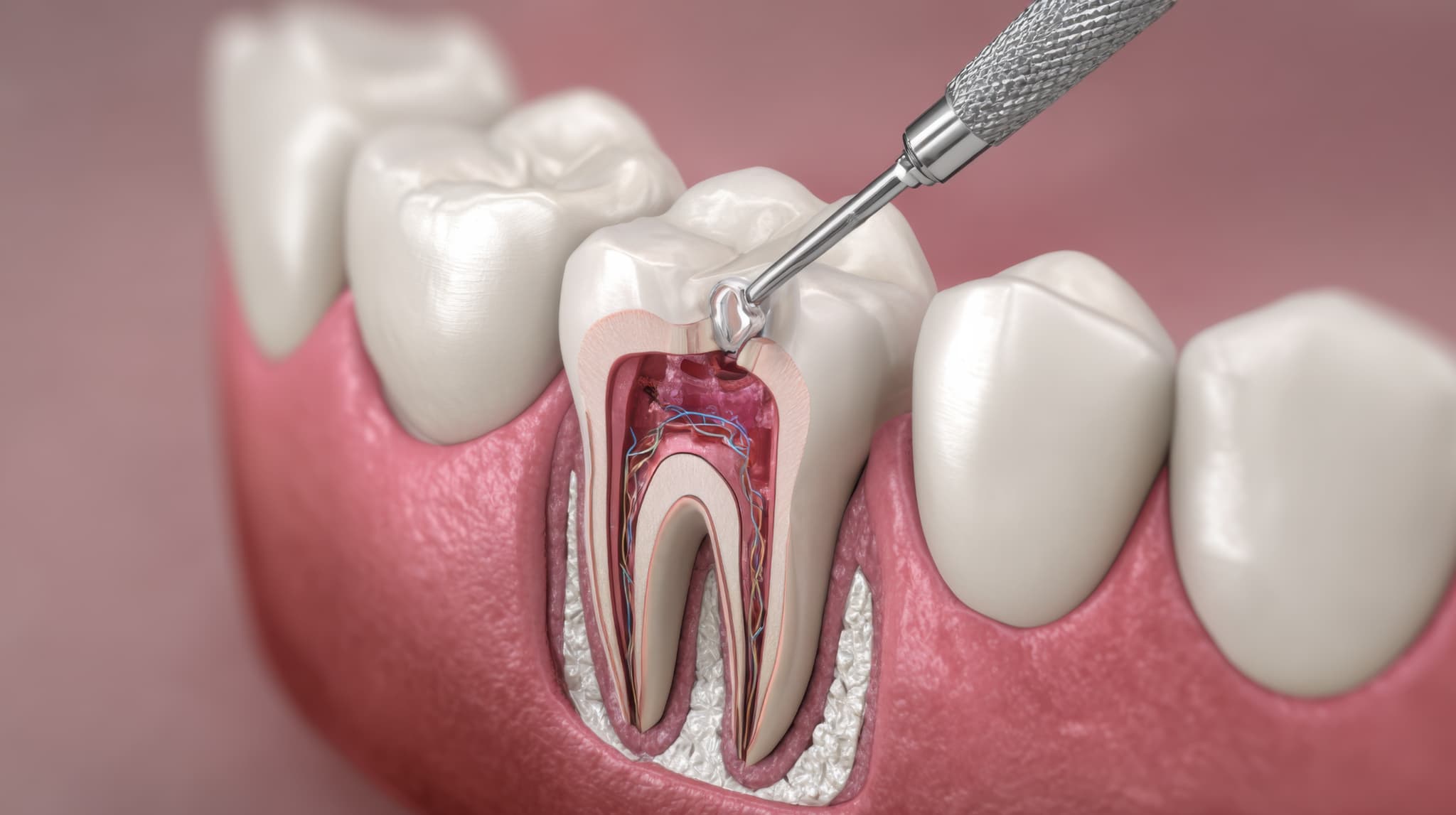 根管治療のイメージ